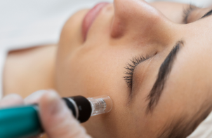 person getting micro needling beauty treatment 1 (1)